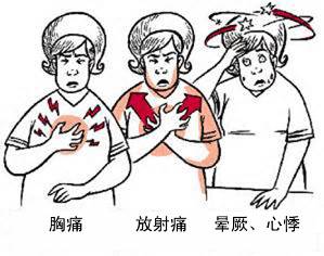 冠心病有哪些癥狀？(圖1)