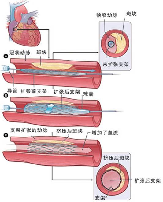 怎樣治療冠心??？(圖2)
