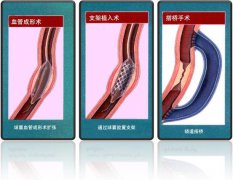 怎樣治療冠心??？