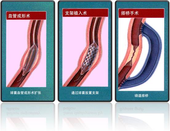 怎樣治療冠心?。?圖1)